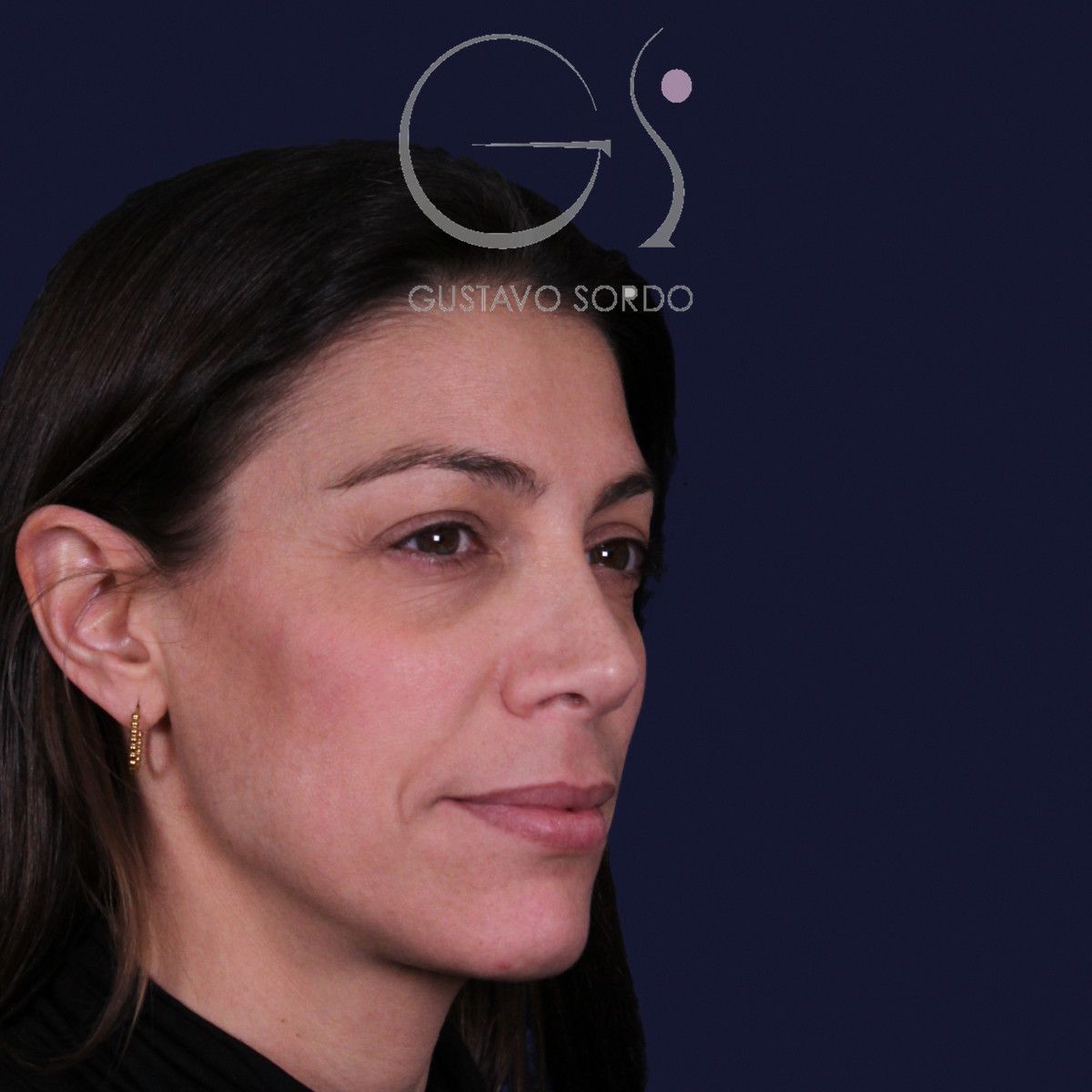 Rinoplastia con columela colgante y ala retraída, semiperfil derecho, a los dos años de la operación