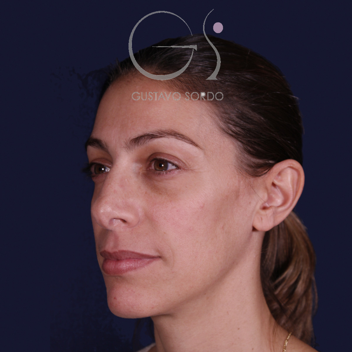 Rinoplastia con columela colgante y ala retraída, semiperfil izquierdo, antes de la operación