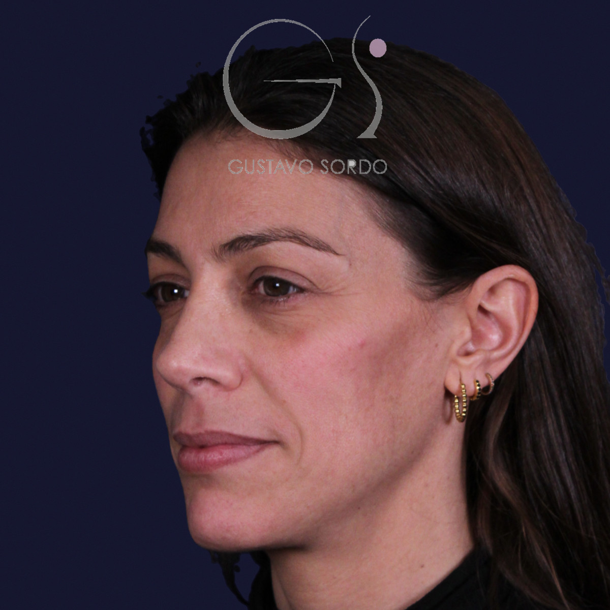 Rinoplastia con columela colgante y ala retraída, semiperfil izquierdo, a los dos años de la operación