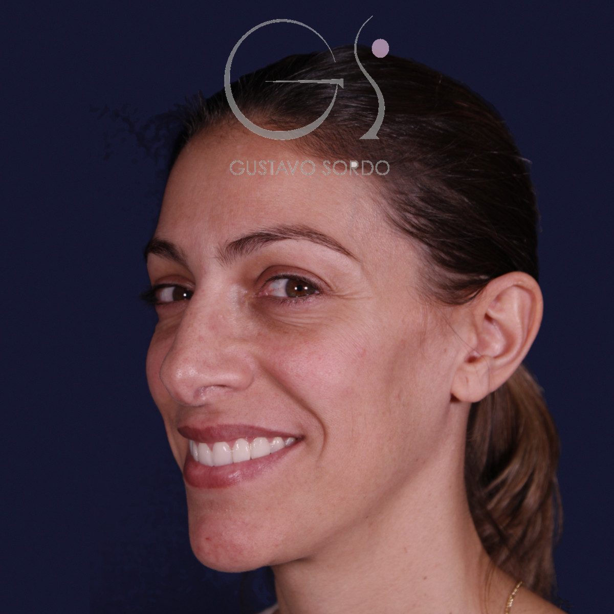 Rinoplastia con columela colgante y ala retraída, semiperfil izquierdo sonriendo, antes de la operación