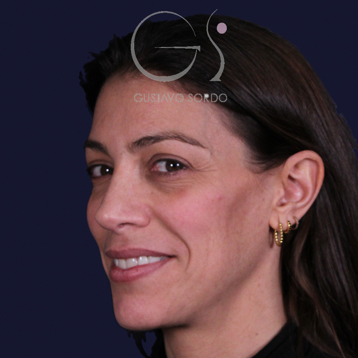 Rinoplastia con columela colgante y ala retraída, semiperfil izquierdo sonriendo, a los dos años de la operación