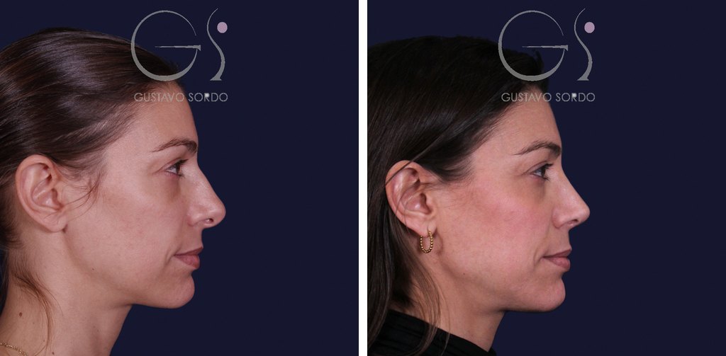 Rinoplastia: antes y después de un caso operado en Madrid