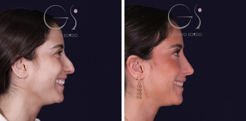 Rinoplastia con dorso recto y resultado natural: antes y después de un caso operado en Madrid