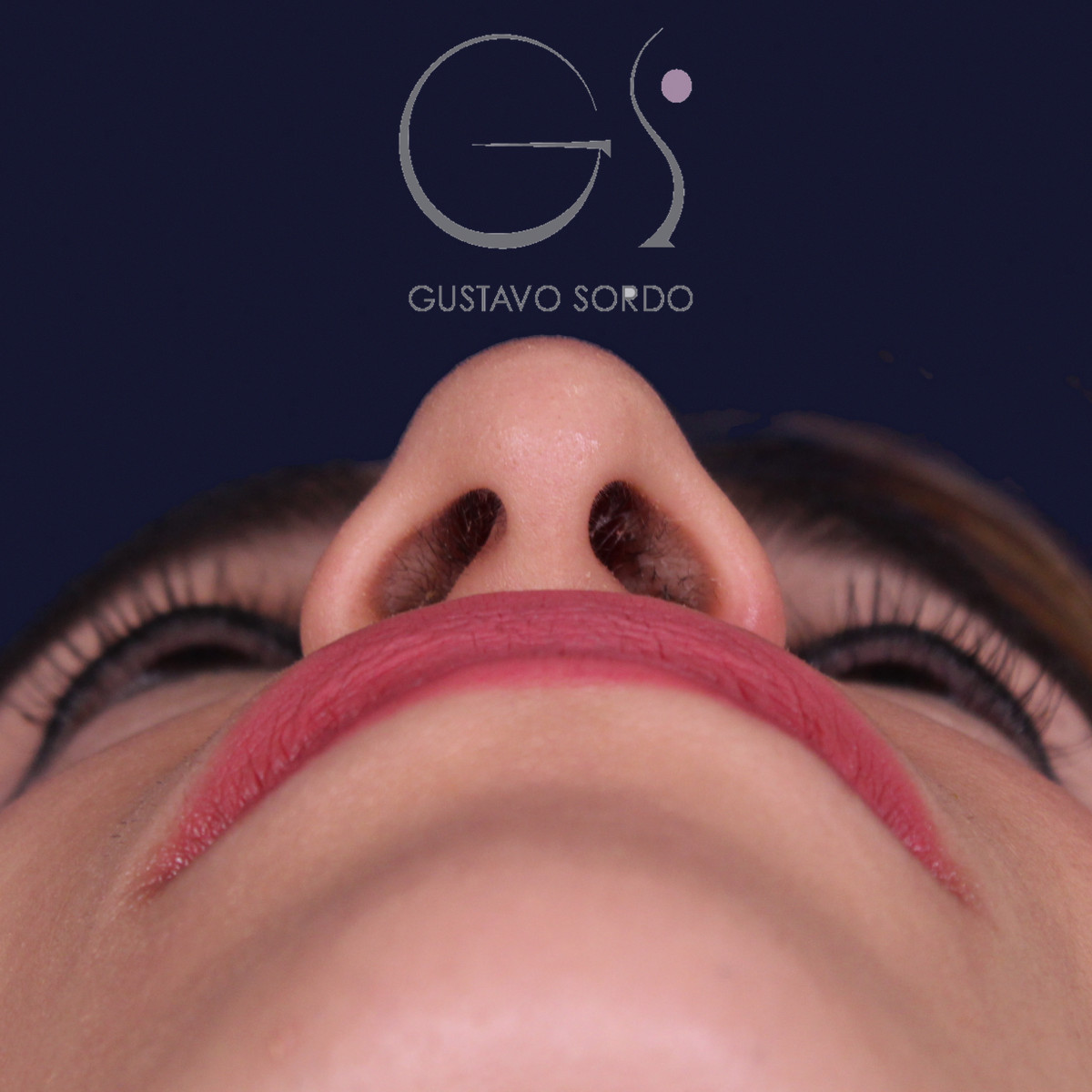 Rinoplastia étnica con punta caída, vista basal, antes de la operación