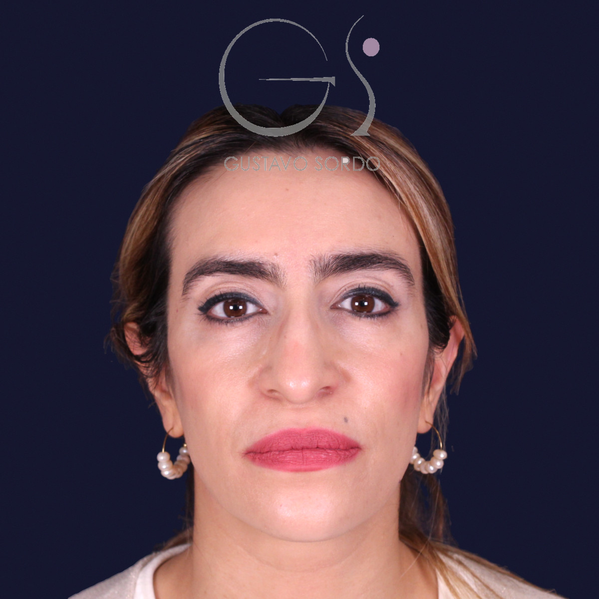 Rinoplastia étnica con punta caída, vista frontal, antes de la operación
