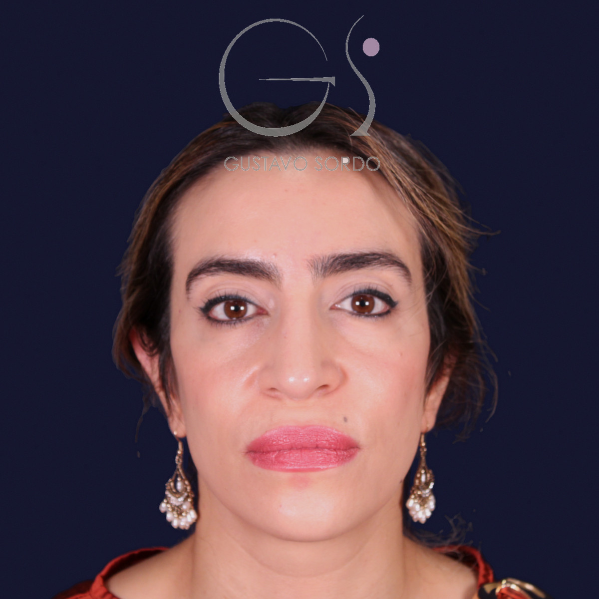 Rinoplastia étnica con punta caída, vista frontal, al año de la operación