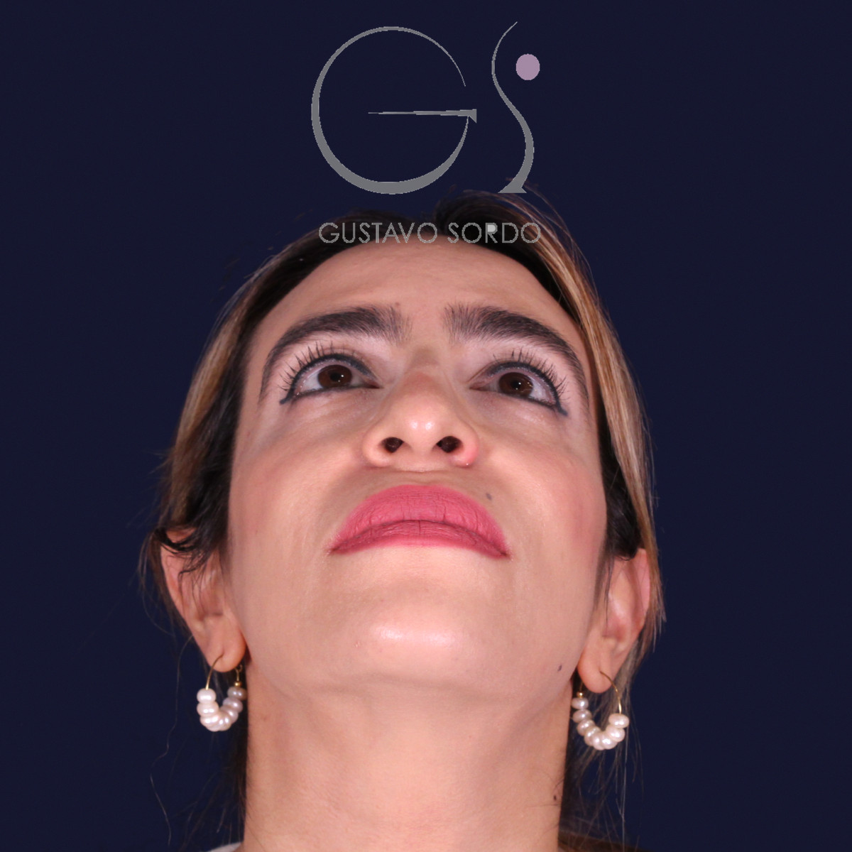 Rinoplastia étnica con punta caída, mentón arriba, antes de la operación