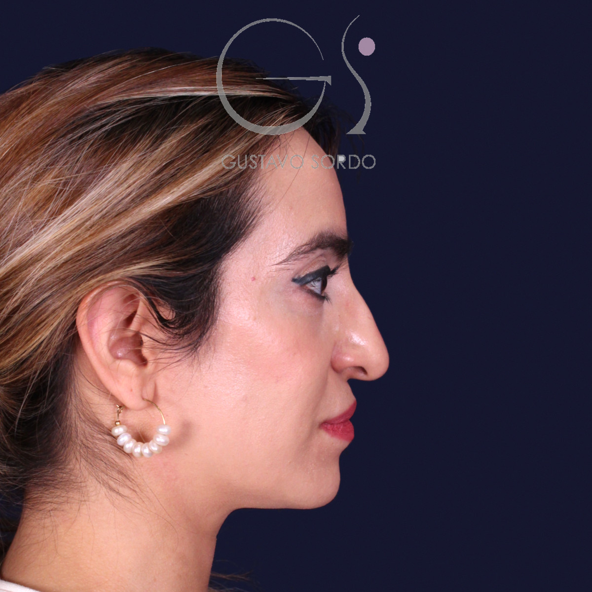 Rinoplastia étnica con punta caída, perfil derecho, antes de la operación