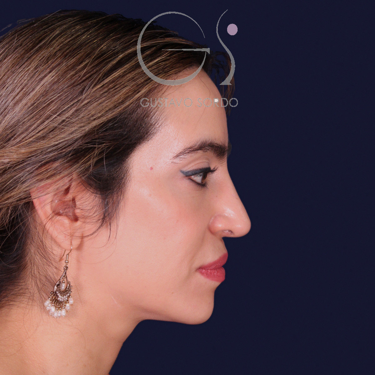 Rinoplastia étnica con punta caída, perfil derecho, al año de la operación