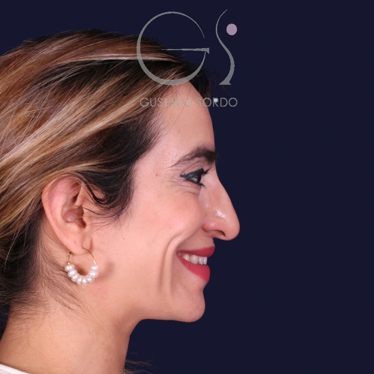 Rinoplastia étnica con punta caída, perfil derecho sonriendo, antes de la operación
