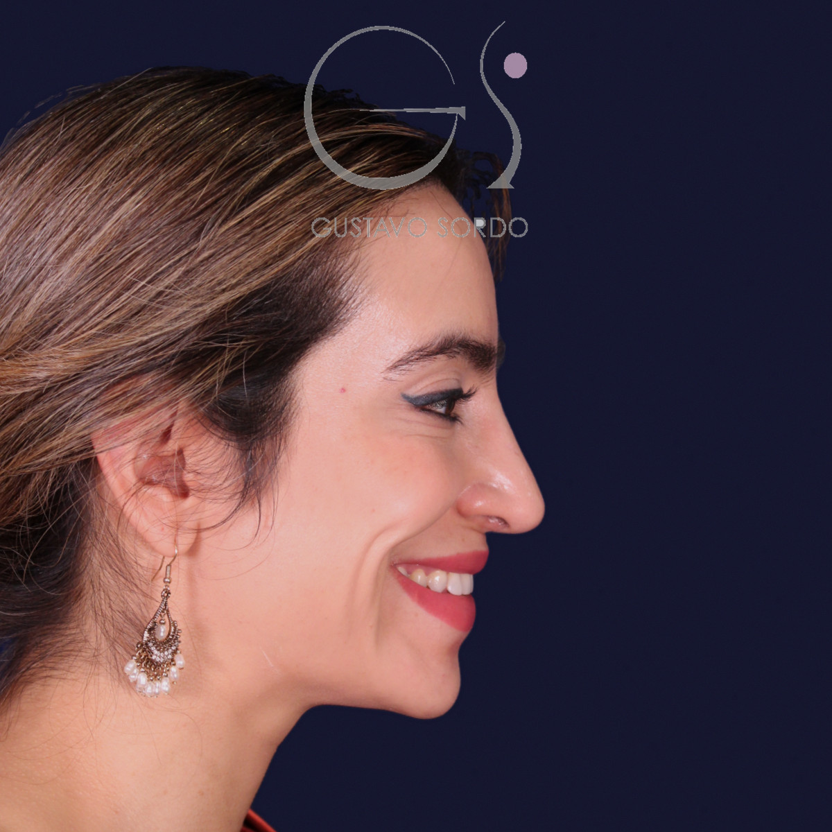 Rinoplastia étnica con punta caída, perfil derecho sonriendo, al año de la operación