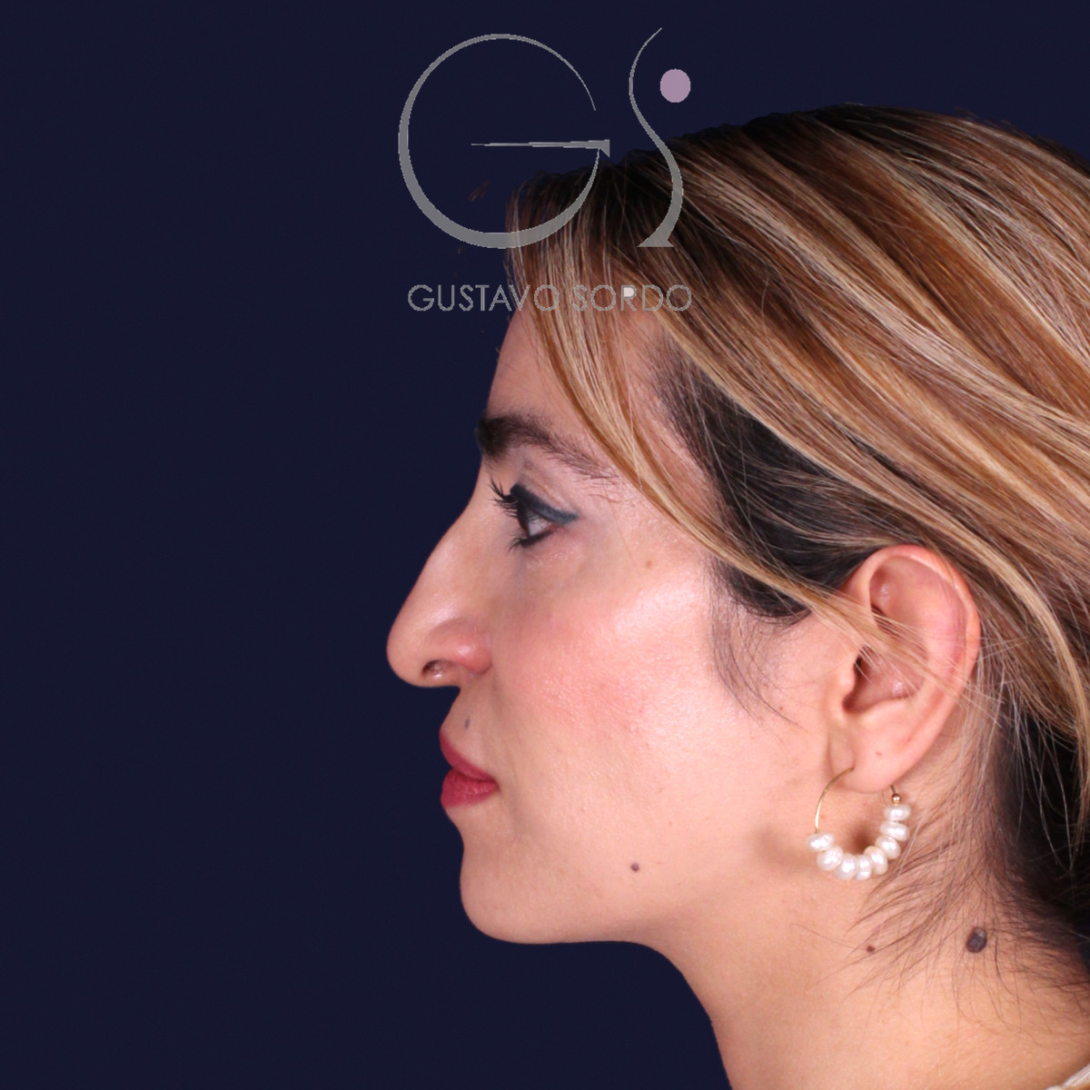 Rinoplastia étnica con punta caída, perfil izquierdo, antes de la operación