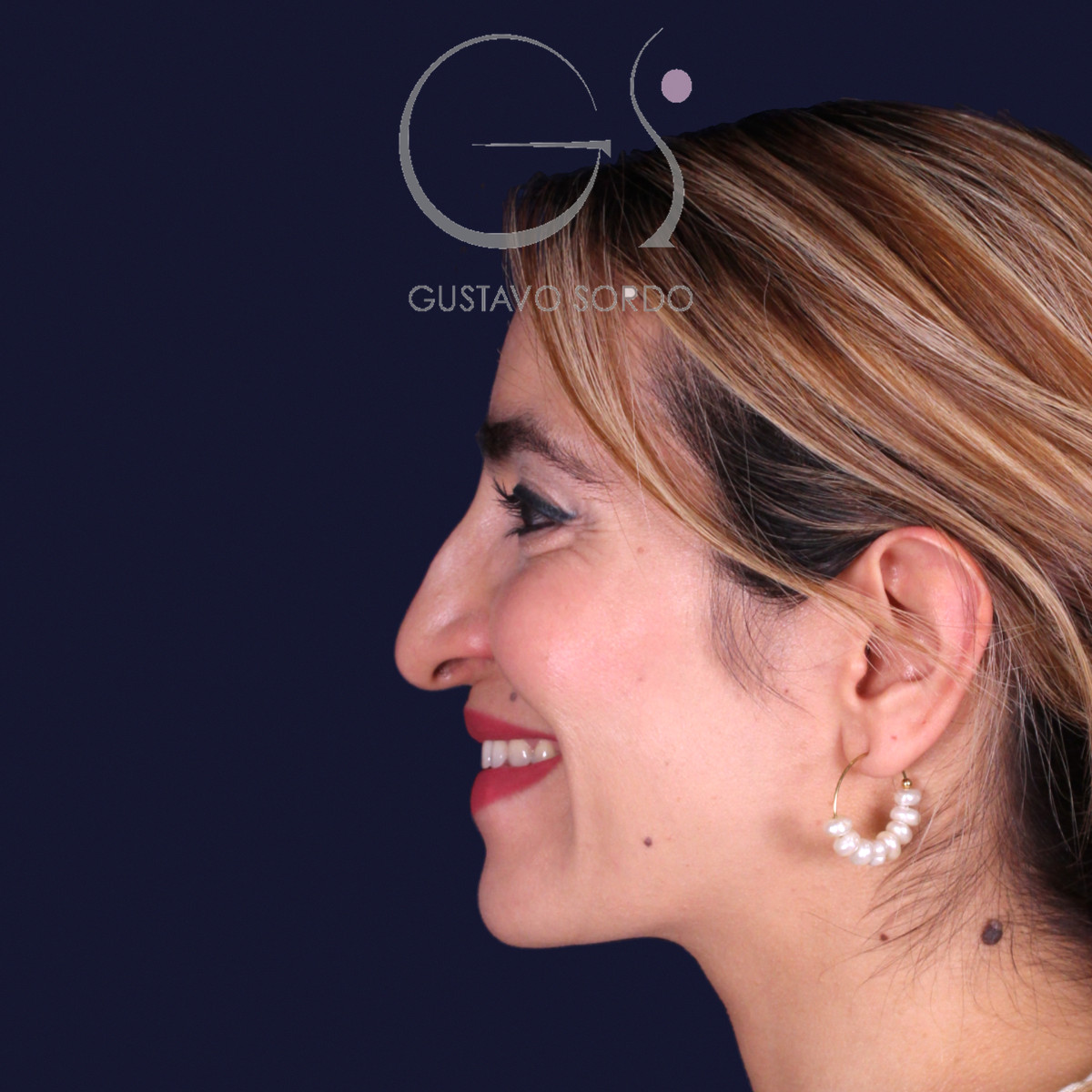 Rinoplastia étnica con punta caída, perfil izquierdo sonriendo, antes de la operación