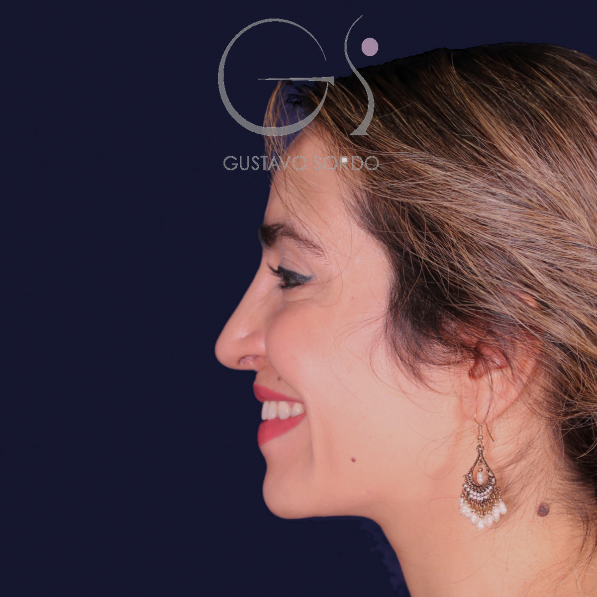 Rinoplastia étnica con punta caída, perfil izquierdo sonriendo, al año de la operación