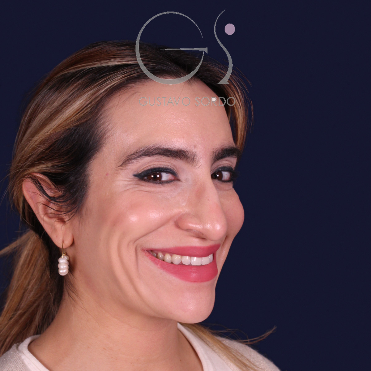 Rinoplastia étnica con punta caída, semiperfil derecho sonriendo, antes de la operación