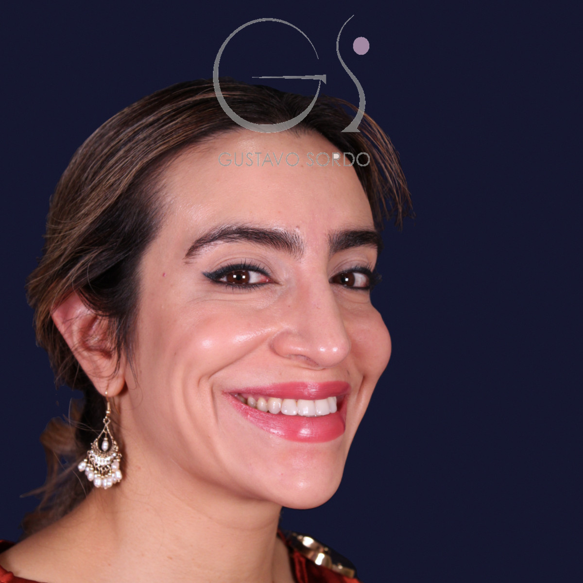 Rinoplastia étnica con punta caída, semiperfil derecho sonriendo, al año de la operación