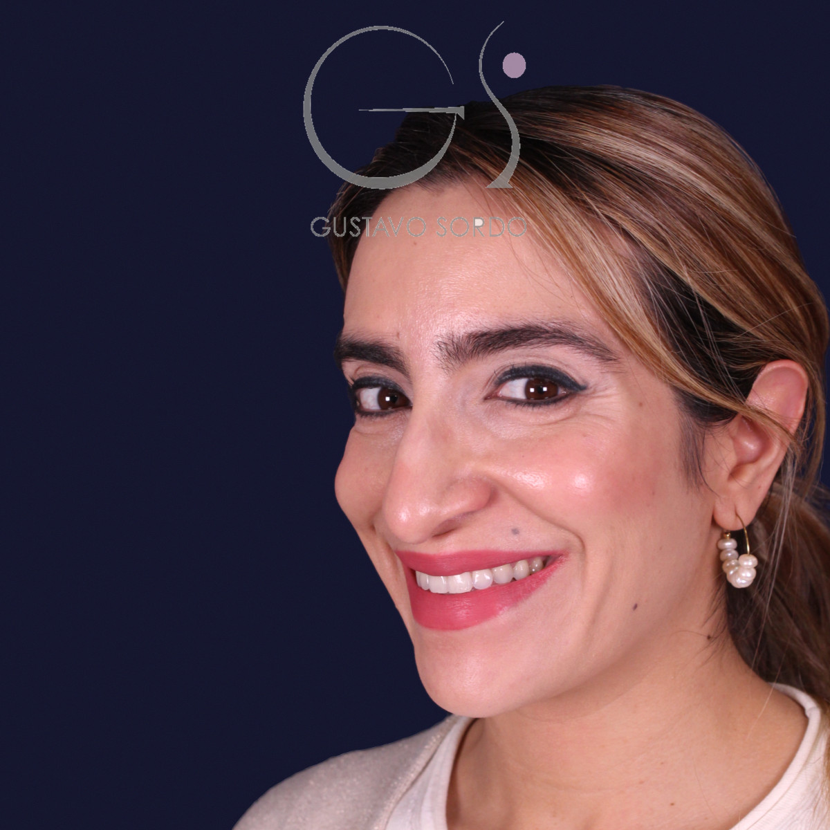 Rinoplastia étnica con punta caída, semiperfil izquierdo sonriendo, antes de la operación
