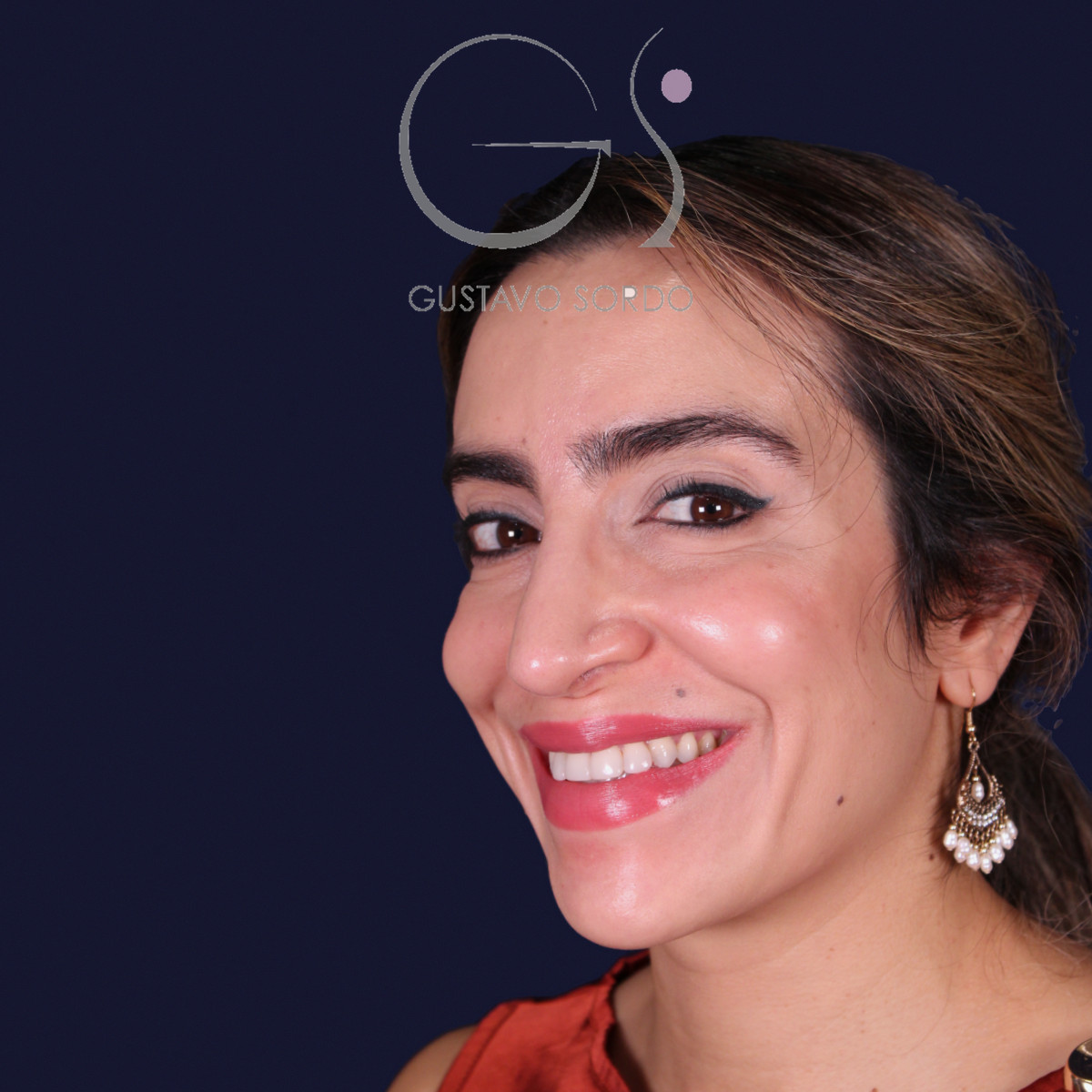 Rinoplastia étnica con punta caída, semiperfil izquierdo sonriendo, al año de la operación