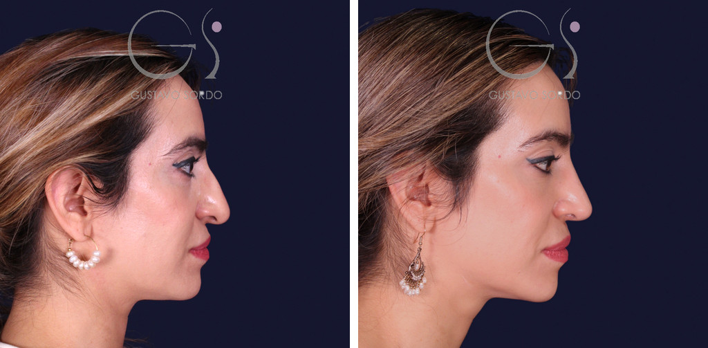 Ethnic rhinoplasty with droopy tip: before and after one year