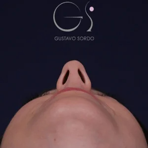 Rinoplastia natural, antes de la cirugía — caso operado por el Dr. Gustavo Sordo en Madrid (4)