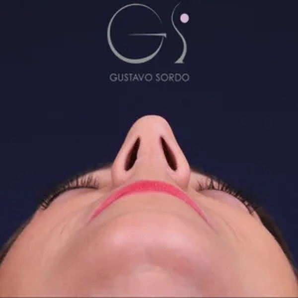 Rinoplastia natural, resultado tras la cirugía — caso operado por el Dr. Gustavo Sordo en Madrid (4)