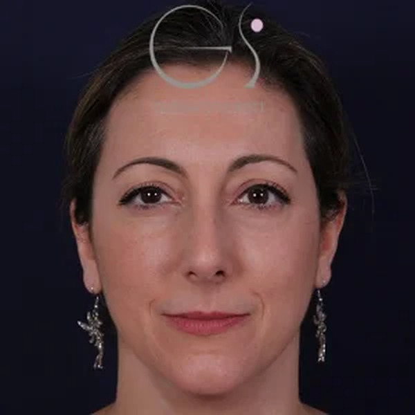 Rinoplastia natural, antes de la cirugía — caso operado por el Dr. Gustavo Sordo en Madrid (1)