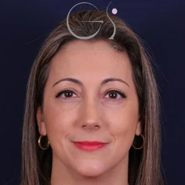 Rinoplastia natural, resultado tras la cirugía — caso operado por el Dr. Gustavo Sordo en Madrid (1)