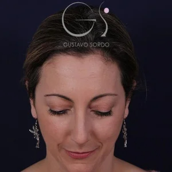 Rinoplastia natural, antes de la cirugía — caso operado por el Dr. Gustavo Sordo en Madrid (3)