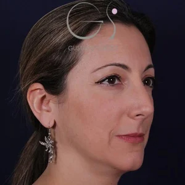 Rinoplastia natural, antes de la cirugía — caso operado por el Dr. Gustavo Sordo en Madrid (7)