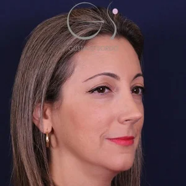Rinoplastia natural, resultado tras la cirugía — caso operado por el Dr. Gustavo Sordo en Madrid (7)