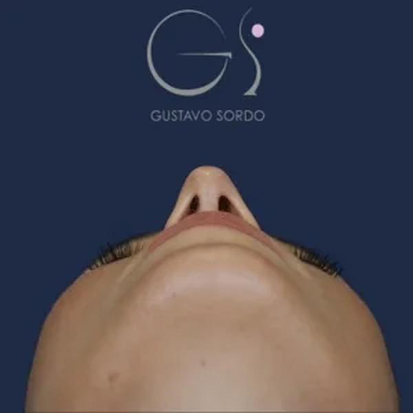 Rinoplastia en mujer, después de la operación (4)