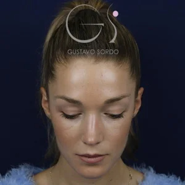 Rinoplastia en mujer, después de la operación (3)