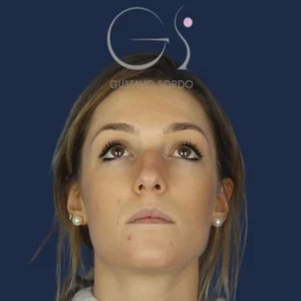 Rinoplastia en mujer, antes de la operación (2)