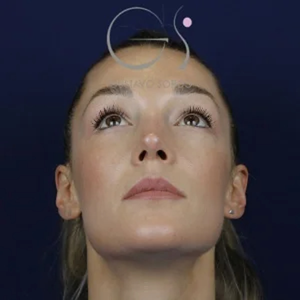 Rinoplastia en mujer, después de la operación (2)