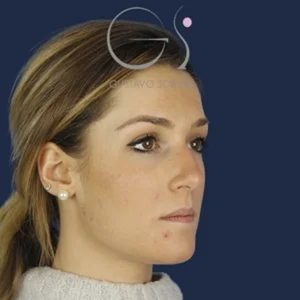 Rinoplastia en mujer, antes de la operación (5)