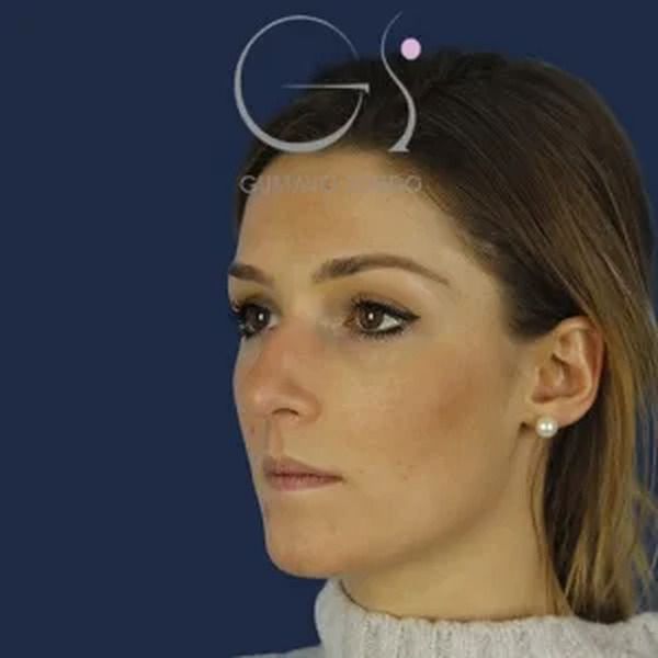 Rinoplastia en mujer, antes de la operación (7)