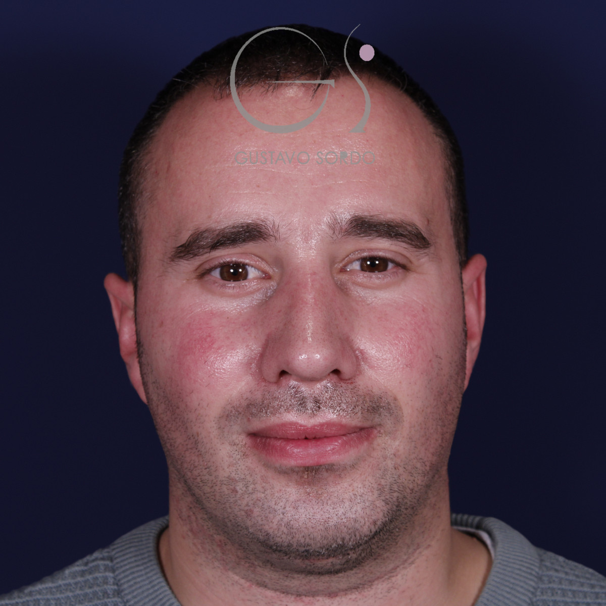 Rinoplastia con mentoplastia en hombre, vista frontal, después de la operación