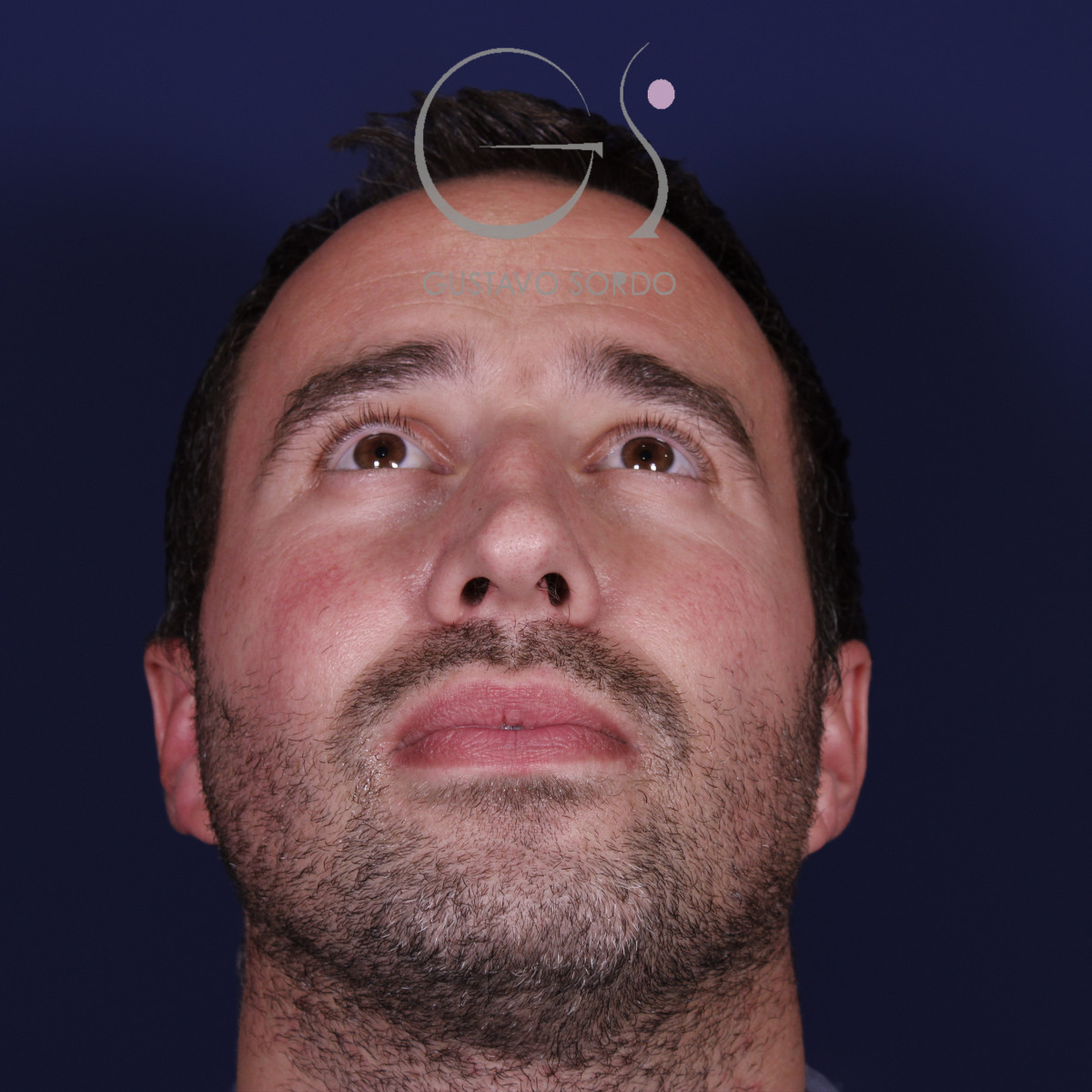 Rinoplastia con mentoplastia en hombre, mentón arriba, antes de la operación