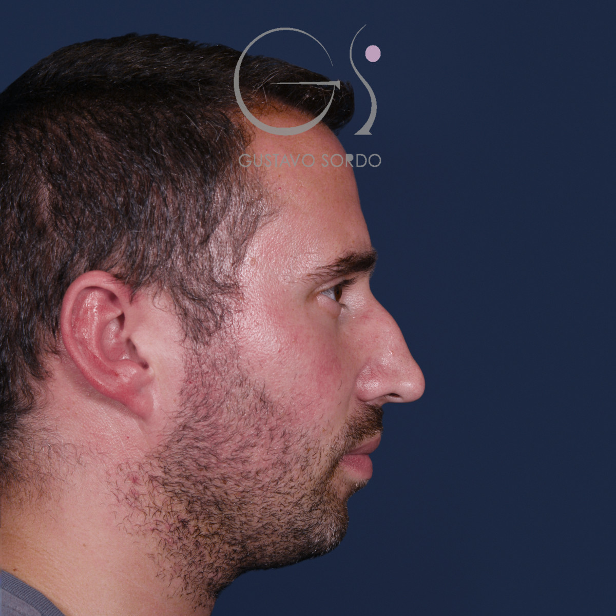 Rinoplastia con mentoplastia en hombre, perfil derecho, antes de la operación