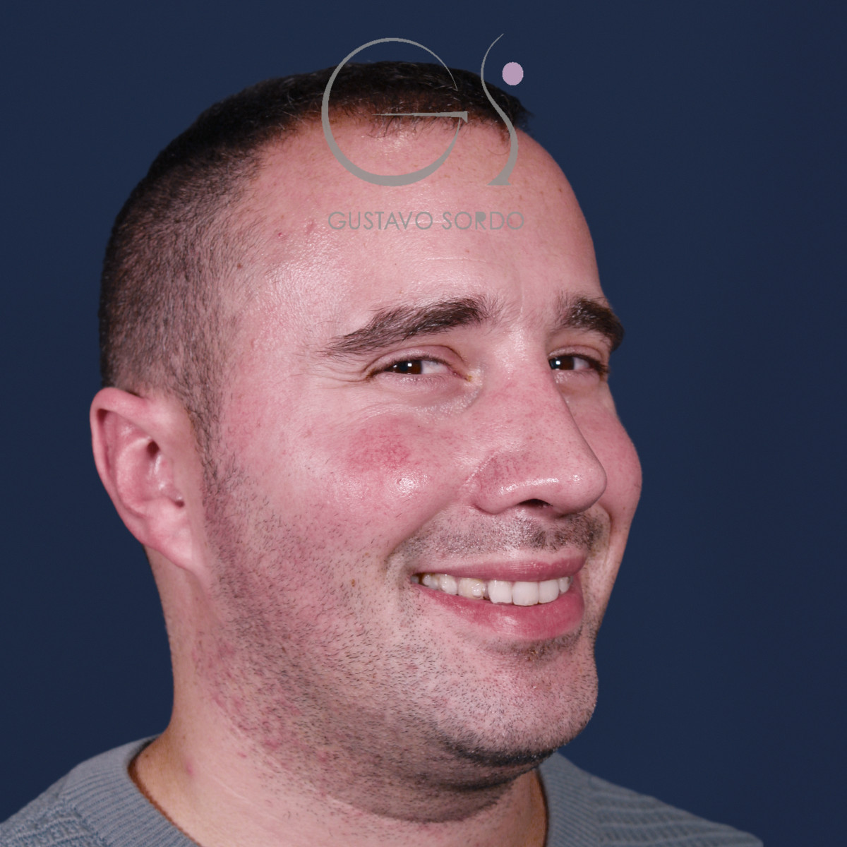 Rinoplastia con mentoplastia en hombre, semiperfil derecho sonriendo, después de la operación