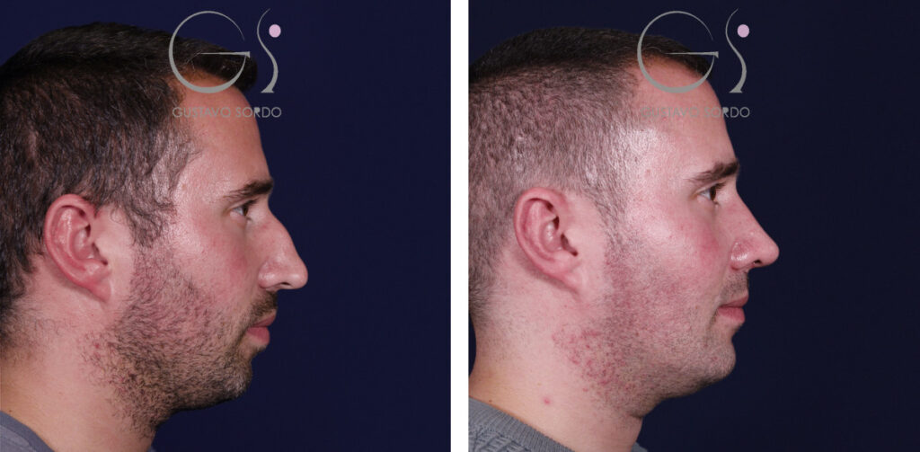 Rinoplastia — en hombre: antes y después de un caso operado en Madrid