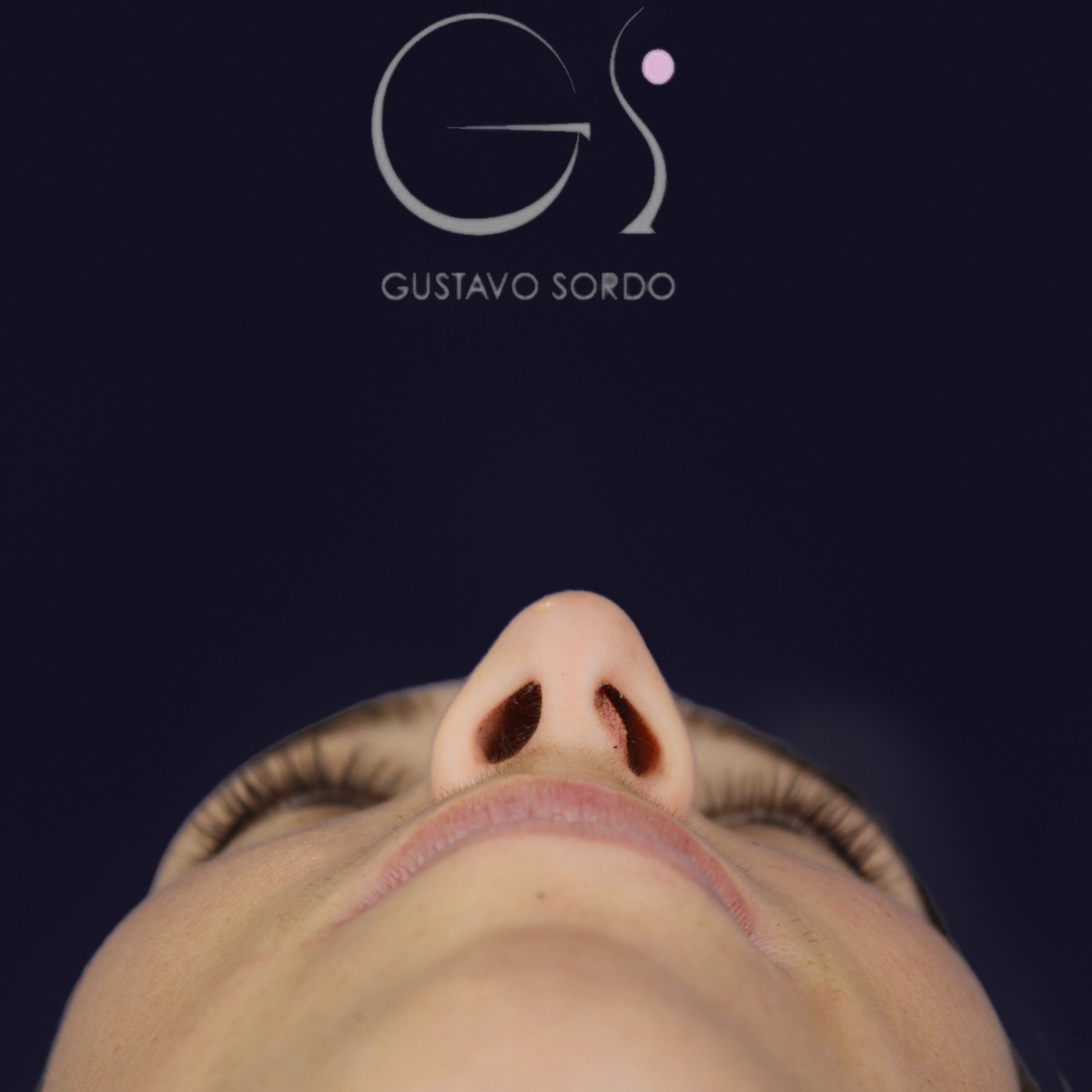 Rinoplastia en nariz aguileña larga, vista basal, antes de la operación