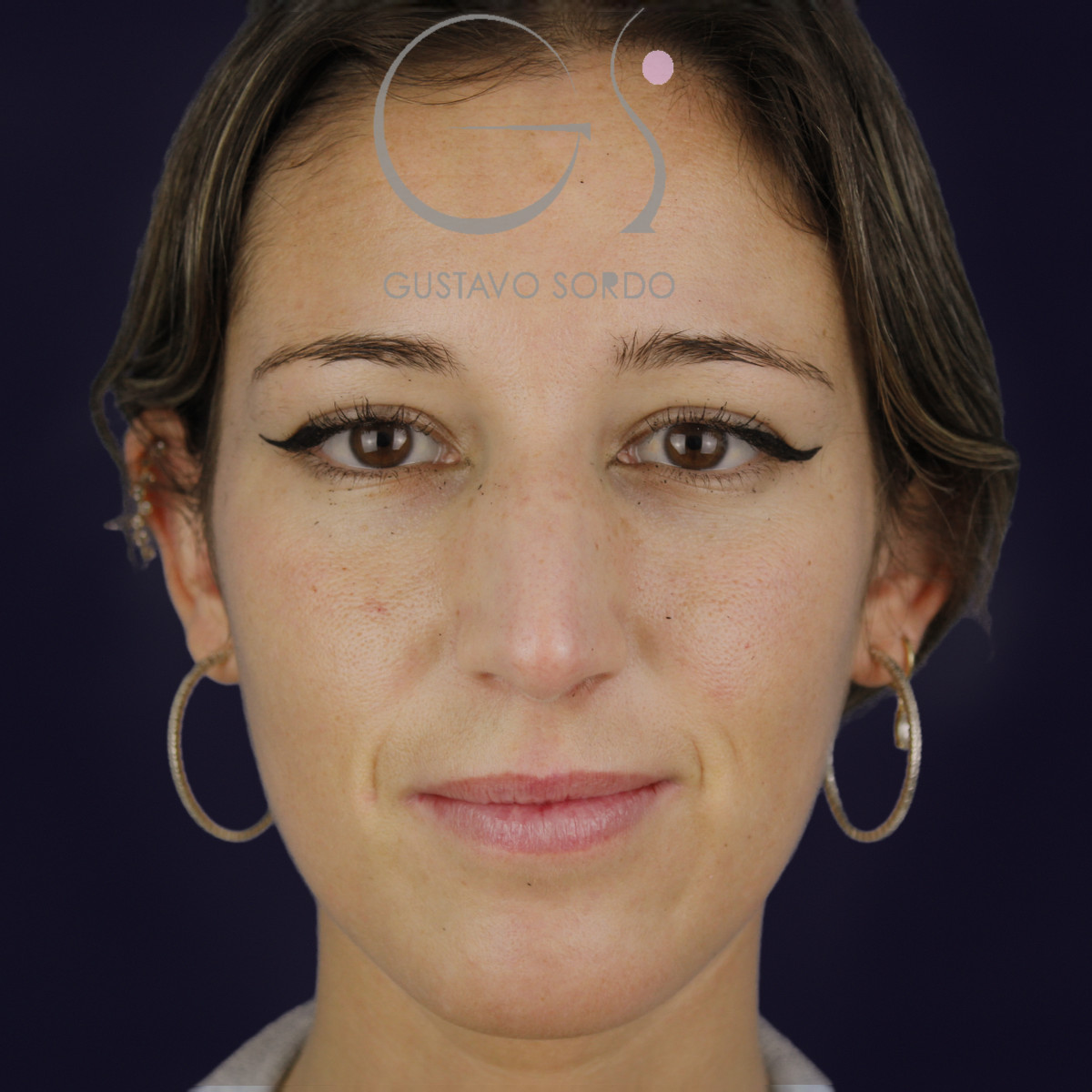 Rinoplastia en nariz aguileña larga, vista frontal, antes de la operación