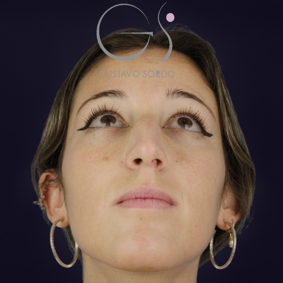 Rinoplastia en nariz aguileña larga, mentón arriba, antes de la operación