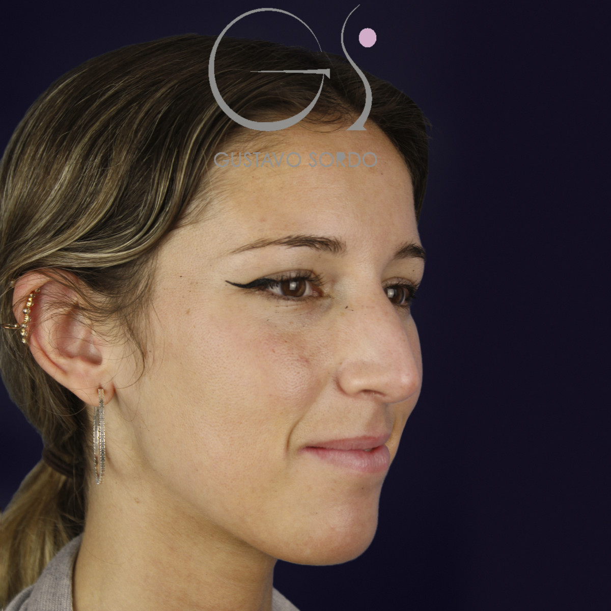 Rinoplastia en nariz aguileña larga, semiperfil derecho, antes de la operación