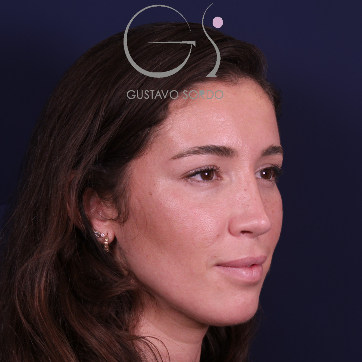 Rinoplastia en nariz aguileña larga, semiperfil derecho, a los cinco años de la operación