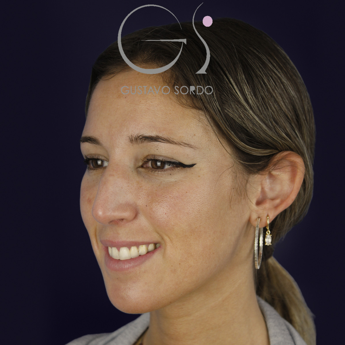 Rinoplastia en nariz aguileña larga, semiperfil izquierdo sonriendo, antes de la operación