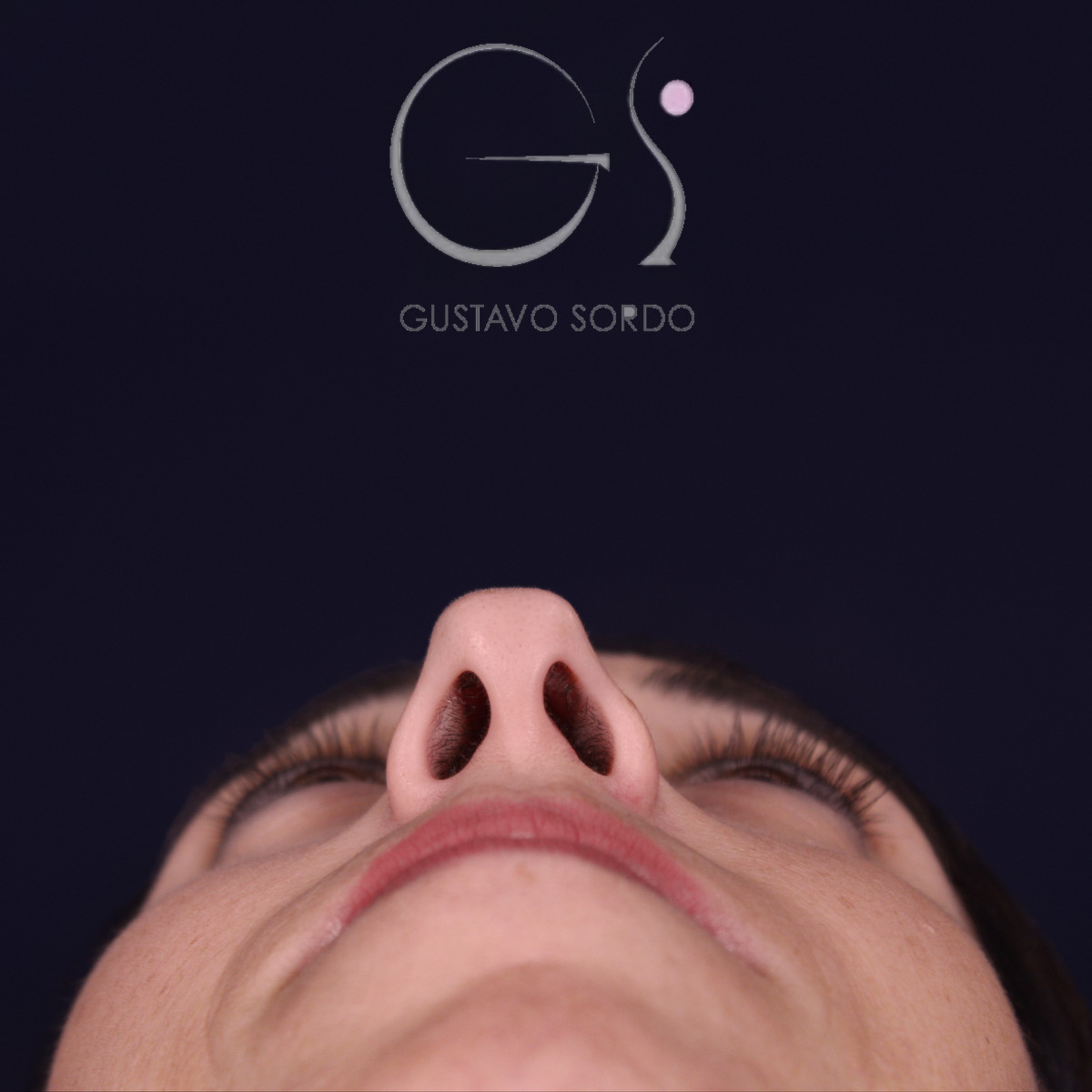 Rinoplastia híbrida en nariz aguileña, vista basal, antes de la operación