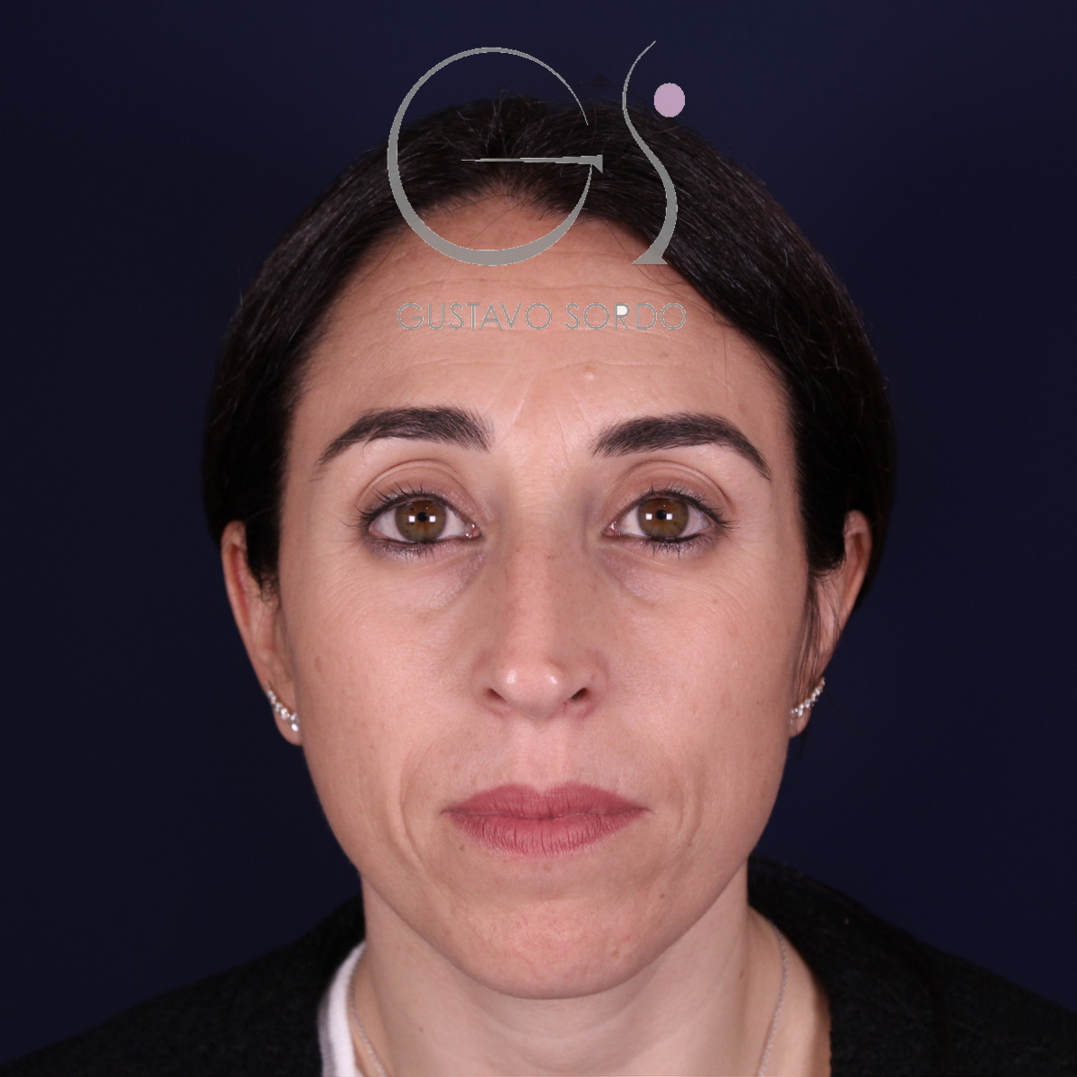 Rinoplastia híbrida en nariz aguileña, vista frontal, antes de la operación