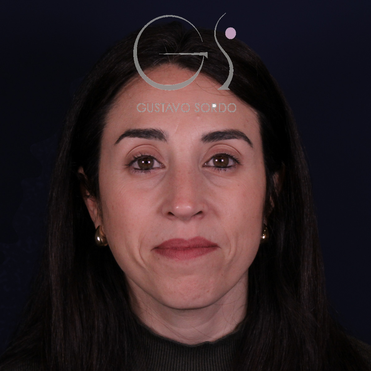 Rinoplastia híbrida en nariz aguileña, vista frontal, a los 6 meses de la operación